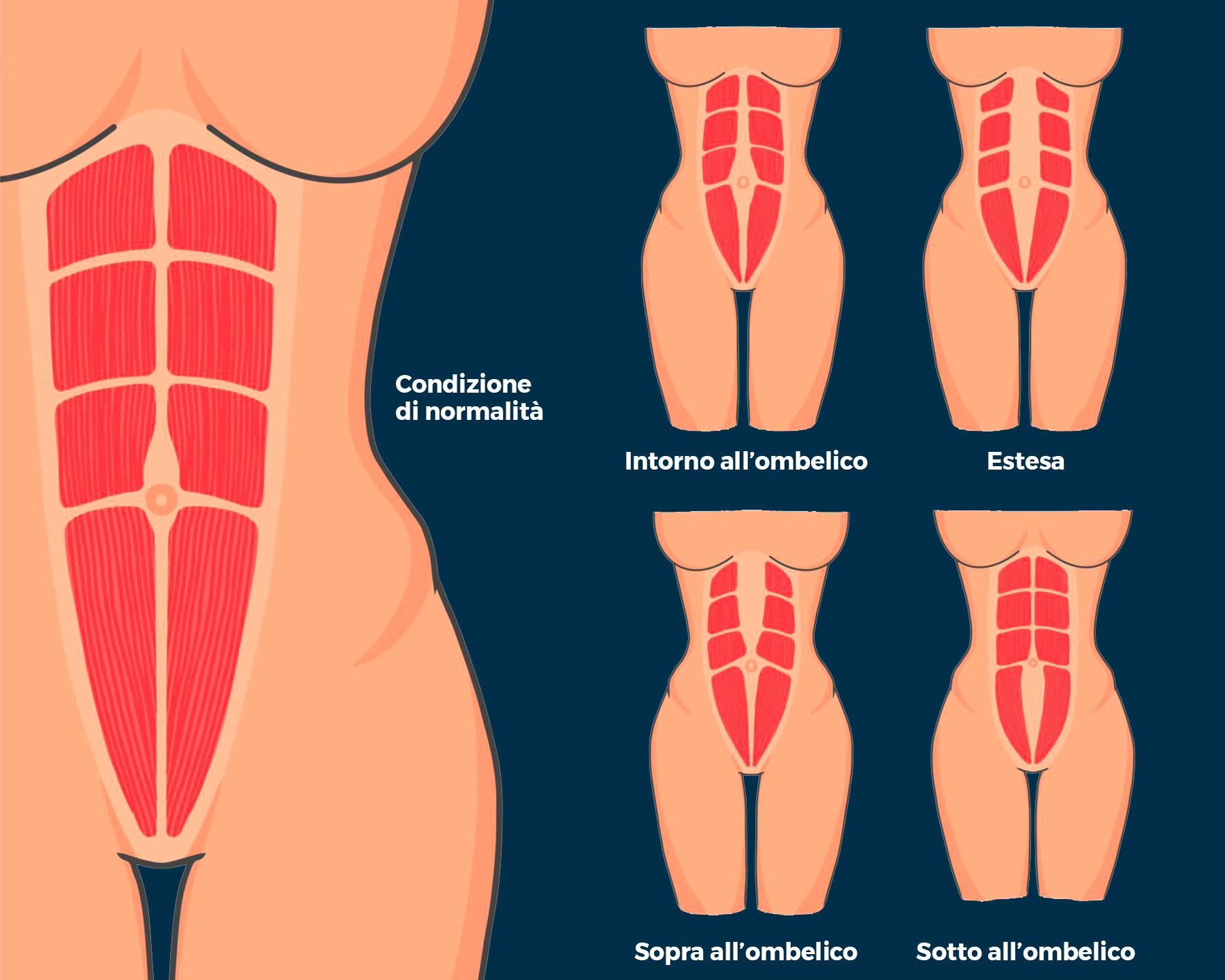 tipologie diastasi addominale